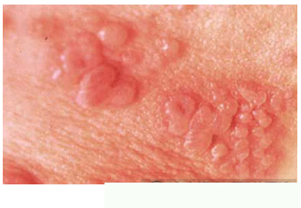 1,生殖器疱疹的通常的症状能够感染身体的以下域:阴茎,阴囊,外阴